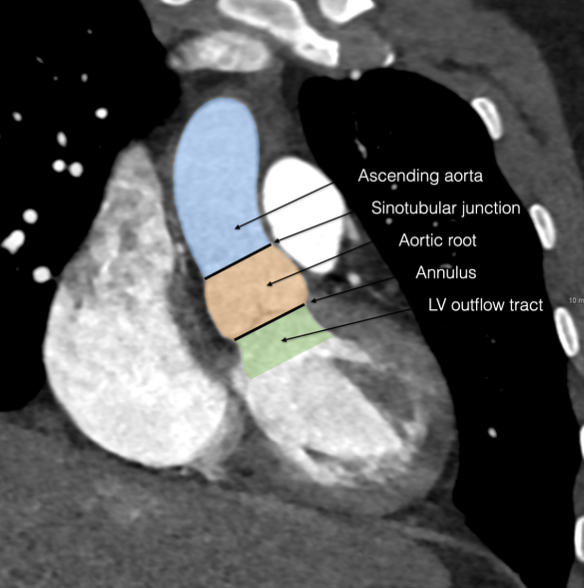 Aortic-root and LVOT anatomy context from the CardiacNexus manuscript image cache