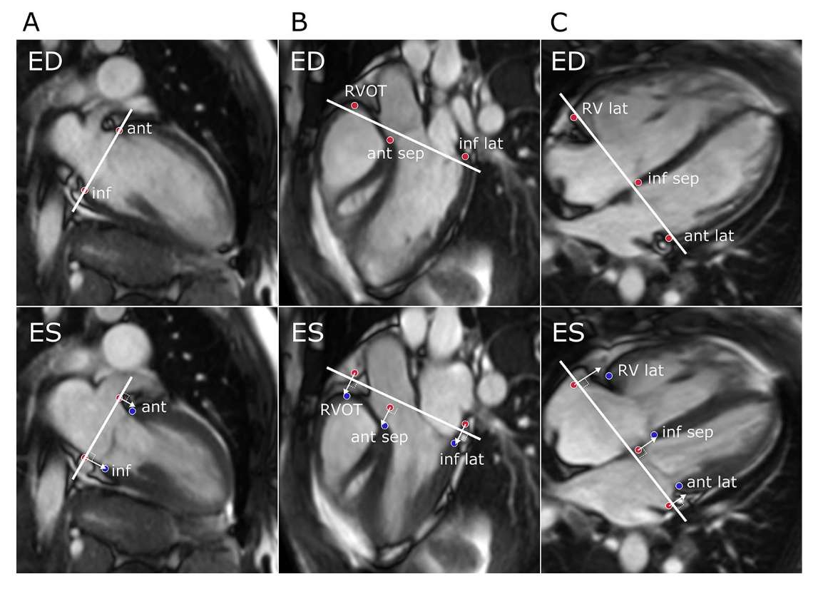 AVPD measurement panel from the CardiacNexus manuscript image cache citing Lindholm et al. 2022