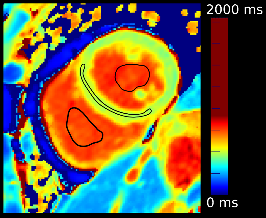 Native T1 region measurement panel for myocardium and blood pools