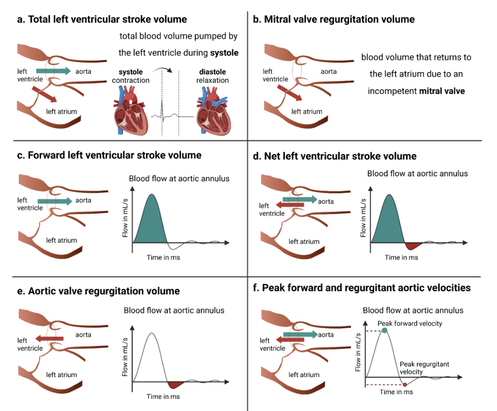 Regurgitant fraction schematic from the CardiacNexus manuscript image cache citing Gomes et al. 2022